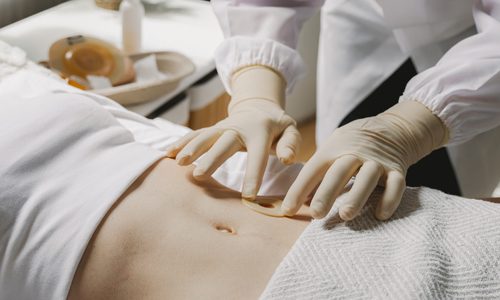 Catheters and Stoma Care image